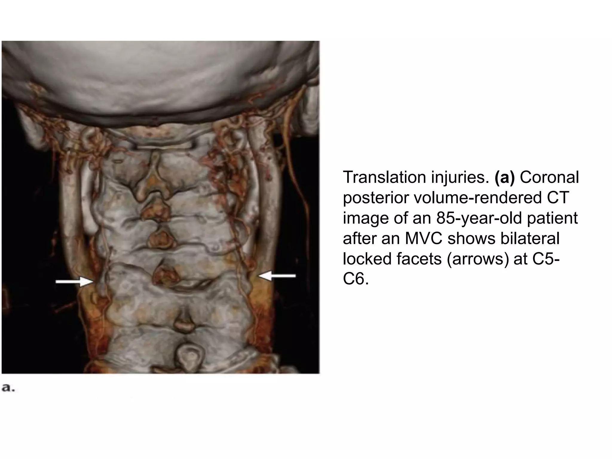 CT Cervical Spine | PPTX