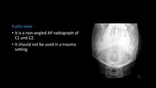 Cervical spine injuries | PPTX