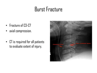 Cst Compression Injury Cervical Fractures and Cervical spine injuries - Dr.KK