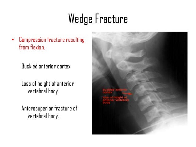 Cervical Fractures and Cervical spine injuries - Dr.KK