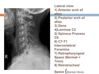Lateral view.
1) Anterior arch of
atlas
2) Posterior arch of
atlas
3) Dens
4)Laminae C2
5) Spinous Process
C6
6) C7-T1
Intervertebral
Foramina
7) Retropharyngeal
Space (Normal <
7mm)
8) Retrotracheal
Space (Normal <2cm).
 