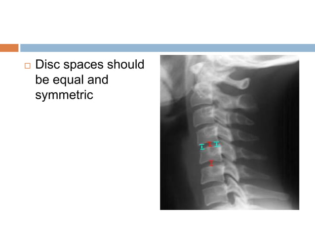 Cd Spine Example C spine positioning | PPTX