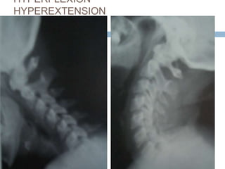 HYPERFLEXION
HYPEREXTENSION
 