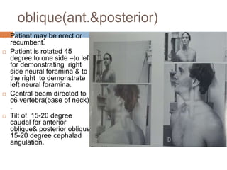 oblique(ant.&posterior)
 Patient may be erect or
recumbent.
 Patient is rotated 45
degree to one side –to left
for demonstrating right
side neural foramina & to
the right to demonstrate
left neural foramina.
 Central beam directed to
c6 vertebra(base of neck)
.
 Tilt of 15-20 degree
caudal for anterior
oblique& posterior oblique
15-20 degree cephalad
angulation.
 