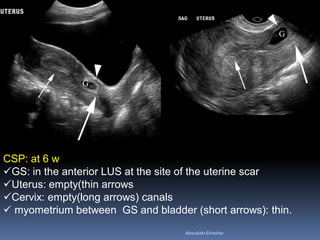CSP: at 6 w
GS: in the anterior LUS at the site of the uterine scar
Uterus: empty(thin arrows
Cervix: empty(long arrows) canals
 myometrium between GS and bladder (short arrows): thin.
AboubakrElnashar
 