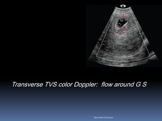 Transverse TVS color Doppler: flow around G S
AboubakrElnashar
 
