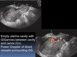 Empty uterine cavity with
GS(arrow) between cavity
and cervix (Cx).
Power Doppler of blood
vessels surrounding GS.
AboubakrElnashar
 