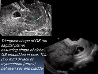 Triangular shape of GS (on
sagittal plane)
assuming shape of niche.
GS embedded in scar. Thin
(1-3 mm) or lack of
myometrium (arrow)
between sac and bladder.
Aboubakr Elnashar
 