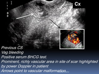 Previous CS
Vag bleeding
Positive serum BHCG test.
Prominent, richly vascular area in site of scar highlighted
by power Doppler in patient
Arrows point to vascular malformation.Aboubakr Elnashar
 