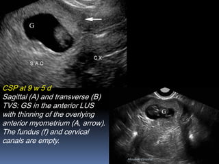 CSP at 9 w 5 d
Sagittal (A) and transverse (B)
TVS: GS in the anterior LUS
with thinning of the overlying
anterior myometrium (A, arrow).
The fundus (f) and cervical
canals are empty.
Aboubakr Elnashar
 