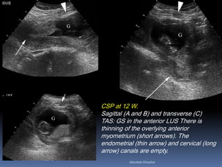 CSP at 12 W.
Sagittal (A and B) and transverse (C)
TAS: GS in the anterior LUS There is
thinning of the overlying anterior
myometrium (short arrows). The
endometrial (thin arrow) and cervical (long
arrow) canals are empty.
Aboubakr Elnashar
 
