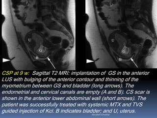 CSP at 9 w: Sagittal T2 MRI: implantation of GS in the anterior
LUS with bulging of the anterior contour and thinning of the
myometrium between GS and bladder (long arrows). The
endometrial and cervical canals are empty (A and B). CS scar is
shown in the anterior lower abdominal wall (short arrows). The
patient was successfully treated with systemic MTX and TVS
guided injection of Kcl. B indicates bladder; and U, uterus.Aboubakr Elnashar
 
