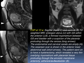 CSP at 12 w: Sagittal (Aand C) and coronal (B) T2-
weighted MRI: enlarged uterus (U) with GS within
the anterior LUS, a thinned myometrium between
GS and bladder with a suspicion of the placenta
protruding through the serosa (long arrows).
The endometrial and cervical canals are empty (A).
The cesarean scar is shown in the anterior lower
abdominal wall (short arrows). The patient went on
to have a hysterectomy, which revealed a very thin
overlying myometrium with placental tissue
protruding through the amniotic membrane
anteriorly, adherent to the bladder (B).Aboubakr Elnashar
 