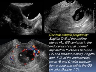 Cervical ectopic pregnancy:
Sagittal TAS of the midline
uterus (A): GS centered in the
endocervical canal, normal
myometrial thickness between
GS and bladder (arrow). Sagittal
and TVS of the endocervical
canal (B and C) with vascular
flow around and within the GS
on color Doppler ( C).Aboubakr Elnashar
 