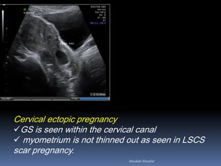 Cervical ectopic pregnancy
GS is seen within the cervical canal
 myometrium is not thinned out as seen in LSCS
scar pregnancy.
Aboubakr Elnashar
 