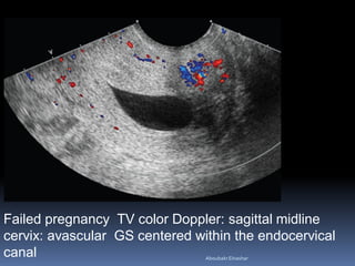 Failed pregnancy TV color Doppler: sagittal midline
cervix: avascular GS centered within the endocervical
canal AboubakrElnashar
 