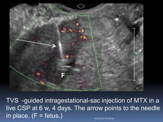 TVS -guided intragestational-sac injection of MTX in a
live CSP at 6 w, 4 days. The arrow points to the needle
in place. (F = fetus.) AboubakrElnashar
 