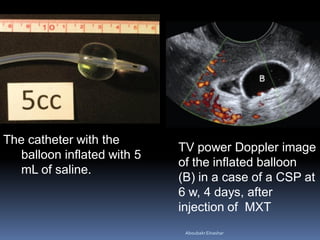 The catheter with the
balloon inflated with 5
mL of saline.
TV power Doppler image
of the inflated balloon
(B) in a case of a CSP at
6 w, 4 days, after
injection of MXT
AboubakrElnashar
 