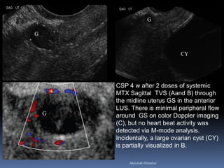 CSP 4 w after 2 doses of systemic
MTX Sagittal TVS (Aand B) through
the midline uterus GS in the anterior
LUS. There is minimal peripheral flow
around GS on color Doppler imaging
(C), but no heart beat activity was
detected via M-mode analysis.
Incidentally, a large ovarian cyst (CY)
is partially visualized in B.
AboubakrElnashar
 
