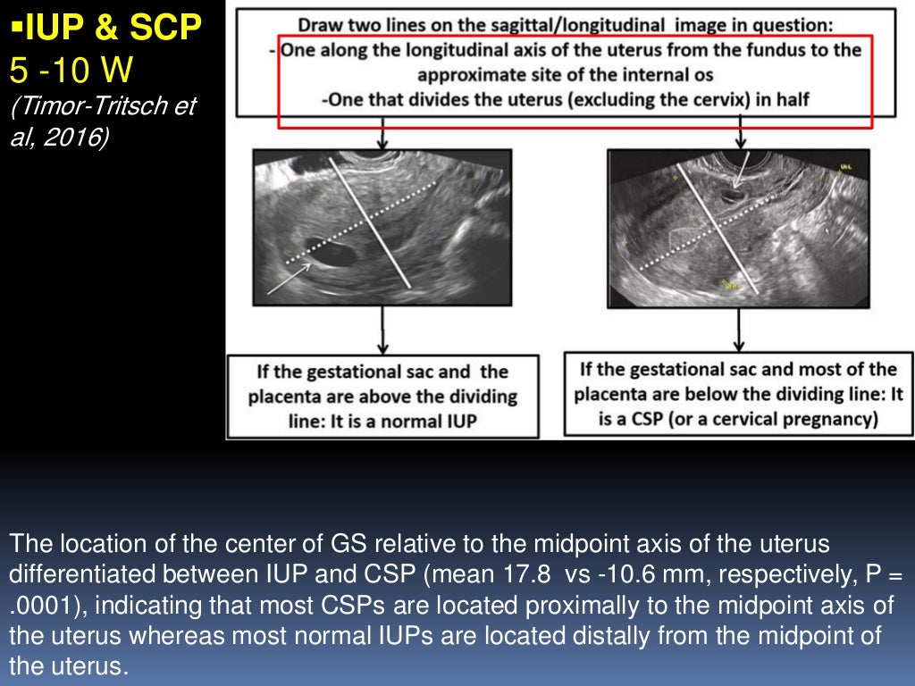 Update on Treatment of Cesarean Scar Pregnancy