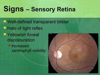 Signs – Sensory Retina
 Well-defined transparent blister
 Halo of light reflex
 Yellowish foveal
discolouration
 Increased
xanthophyll visibility
 