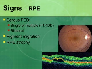 Signs – RPE
 Serous PED:
 Single or multiple (<1/4DD)
 Bilateral
 Pigment migration
 RPE atrophy
 