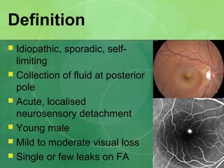 Definition
 Idiopathic, sporadic, self-
limiting
 Collection of fluid at posterior
pole
 Acute, localised
neurosensory detachment
 Young male
 Mild to moderate visual loss
 Single or few leaks on FA
 