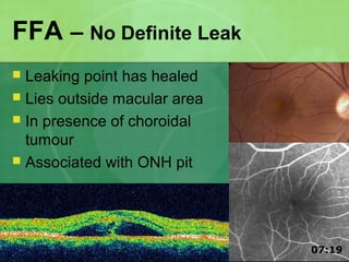 FFA – No Definite Leak
 Leaking point has healed
 Lies outside macular area
 In presence of choroidal
tumour
 Associated with ONH pit
07:19
 