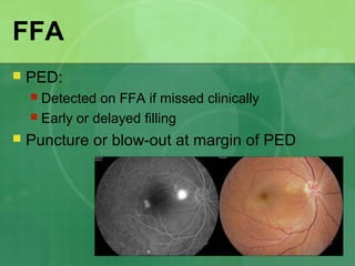 FFA
 PED:
 Detected on FFA if missed clinically
 Early or delayed filling
 Puncture or blow-out at margin of PED
 