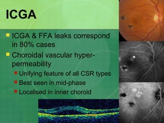 ICGA
 ICGA & FFA leaks correspond
in 80% cases
 Choroidal vascular hyper-
permeability
 Unifying feature of all CSR types
 Best seen in mid-phase
 Localised in inner choroid
 