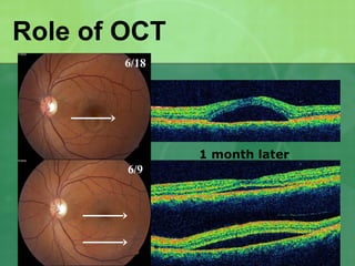 Role of OCT
1 month later
6/18
6/9
 
