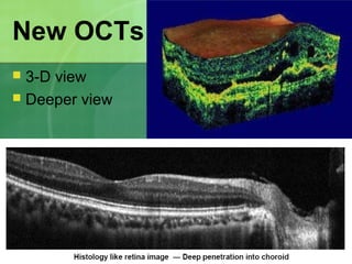 New OCTs
 3-D view
 Deeper view
 
