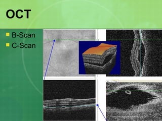 OCT
 B-Scan
 C-Scan
 
