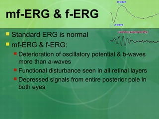 mf-ERG & f-ERG
 Standard ERG is normal
 mf-ERG & f-ERG:
 Deterioration of oscillatory potential & b-waves
more than a-waves
 Functional disturbance seen in all retinal layers
 Depressed signals from entire posterior pole in
both eyes
 
