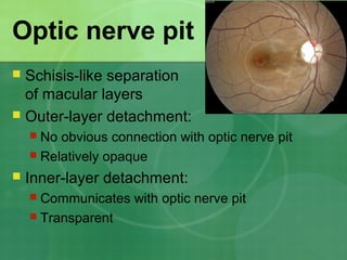 Optic nerve pit
 Schisis-like separation
of macular layers
 Outer-layer detachment:
 No obvious connection with optic nerve pit
 Relatively opaque
 Inner-layer detachment:
 Communicates with optic nerve pit
 Transparent
 
