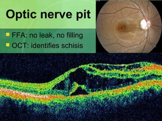 Optic nerve pit
 FFA: no leak, no filling
 OCT: identifies schisis
 