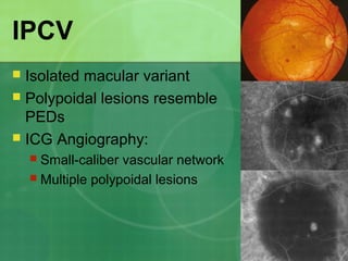 IPCV
 Isolated macular variant
 Polypoidal lesions resemble
PEDs
 ICG Angiography:
 Small-caliber vascular network
 Multiple polypoidal lesions
 