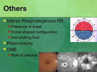 Others
 Inferior Rhegmatogenous RD
 Presence of break
 Dome shaped configuration
 Non-shifting fluid
 Photo-toxicity
 CME
 Role of steroids
 