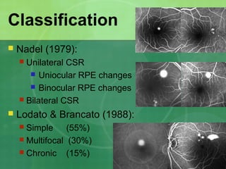 Classification
 Nadel (1979):
 Unilateral CSR
 Uniocular RPE changes
 Binocular RPE changes
 Bilateral CSR
 Lodato & Brancato (1988):
 Simple (55%)
 Multifocal (30%)
 Chronic (15%)
 
