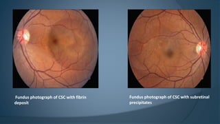 Fundus photograph of CSC with fibrin
deposit
Fundus photograph of CSC with subretinal
precipitates
 