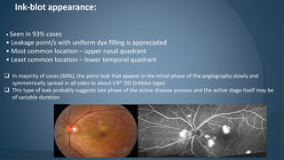 Ink-blot appearance:
• Seen in 93% cases
• Leakage point/s with uniform dye filling is appreciated
• Most common location – upper nasal quadrant
• Least common location – lower temporal quadrant
 In majority of cases (60%), the point leak that appear in the initial phase of the angiography slowly and
symmetrically spread in all sides to about l/4th DD (inkblot type)
 This type of leak probably suggests late phase of the active disease process and the active stage itself may be
of variable duration
 
