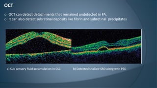 OCT
o OCT can detect detachments that remained undetected in FA.
o It can also detect subretinal deposits like fibrin and subretinal precipitates
a) Sub sensory fluid accumulation in CSC b) Detected shallow SRD along with PED
 