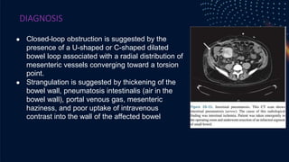 DIAGNOSIS
● Closed-loop obstruction is suggested by the
presence of a U-shaped or C-shaped dilated
bowel loop associated with a radial distribution of
mesenteric vessels converging toward a torsion
point.
● Strangulation is suggested by thickening of the
bowel wall, pneumatosis intestinalis (air in the
bowel wall), portal venous gas, mesenteric
haziness, and poor uptake of intravenous
contrast into the wall of the affected bowel
 