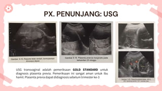 USG transvaginal adalah pemeriksaan GOLD STANDARD untuk
diagnosis plasenta previa. Pemeriksaan ini sangat aman untuk ibu
hamil. Plasenta previa dapat didiagnosis sebelum trimester ke-3
PX. PENUNJANG: USG
 