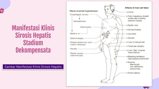 Manifestasi Klinis
Sirosis Hepatis
Stadium
Dekompensata
Gambar Manifestasi Klinis Sirosis Hepatis
 