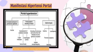 Manifestasi Hipertensi Portal
Gambar Manifestasi klinis hipertensi portal
 