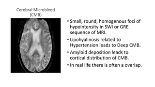 Cerebral Microbleed
(CMB)
• Small, round, homogenous foci of
hypointensity in SWI or GRE
sequence of MRI.
• Lipohyalinosis related to
Hypertension leads to Deep CMB.
• Amyloid deposition leads to
cortical distribution of CMB.
• In real life there is often a overlap.
 