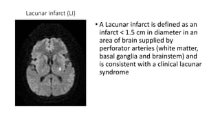 Lacunar infarct (LI)
• A Lacunar infarct is defined as an
infarct < 1.5 cm in diameter in an
area of brain supplied by
perforator arteries (white matter,
basal ganglia and brainstem) and
is consistent with a clinical lacunar
syndrome
 