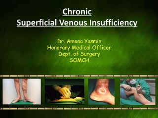 Chronic
Superficial Venous Insufficiency
Dr. Amena Yasmin
Honorary Medical Officer
Dept. of Surgery
SOMCH
 