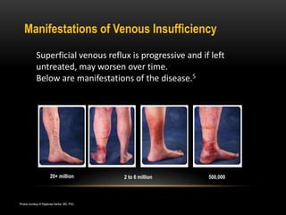 20+ million 2 to 6 million
Skin Ulcers
500,000
Manifestations of Venous Insufficiency
Superficial venous reflux is progressive and if left
untreated, may worsen over time.
Below are manifestations of the disease.5
Photos courtesy of Rajabrata Sarkar, MD, PhD.
Swollen Legs Skin ChangesVaricose Veins
 